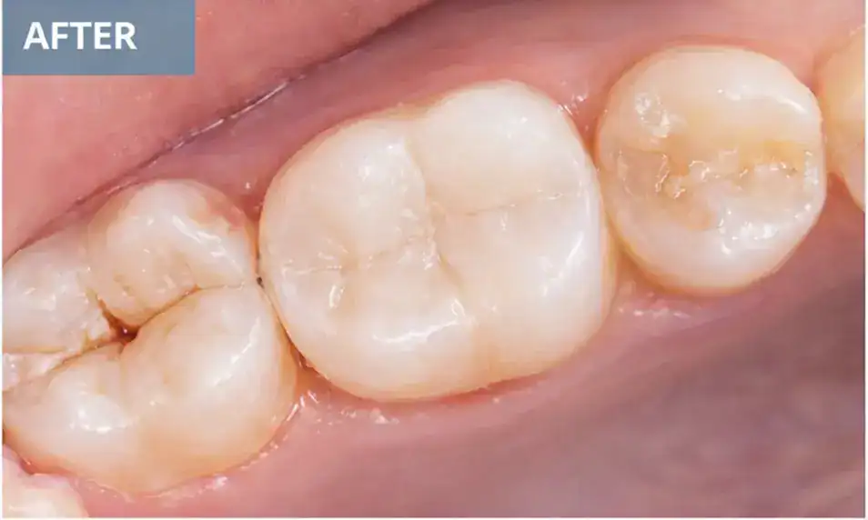 After Root canal treatment Healthy teeth after root canal treatment