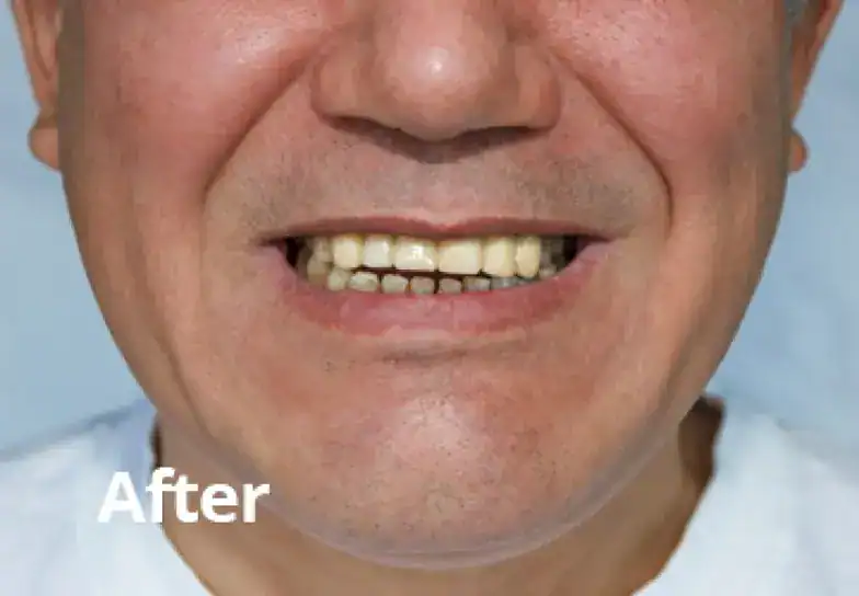 After dental bridge treatment After dental bridge treatment