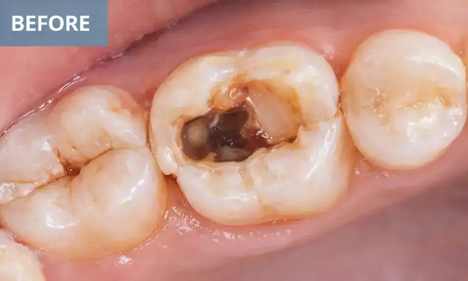 Before Root canal treatment Tooth with visible decay and damage