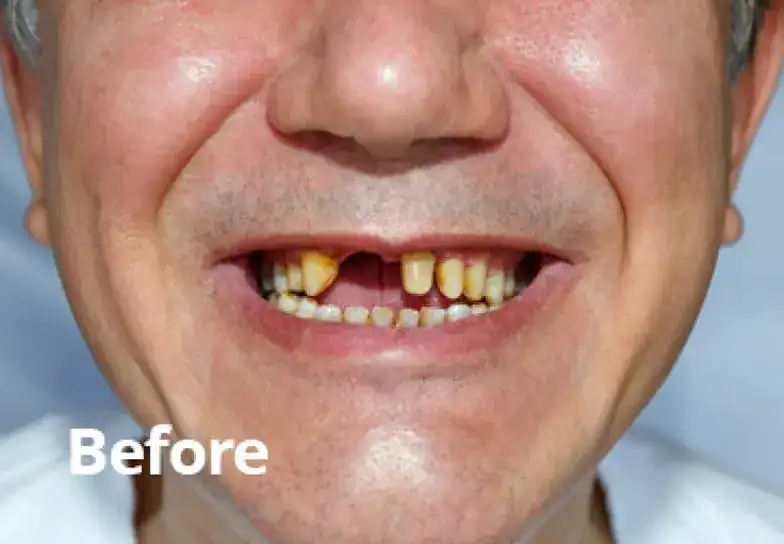 Before dental bridge treatment Before dental bridge treatment