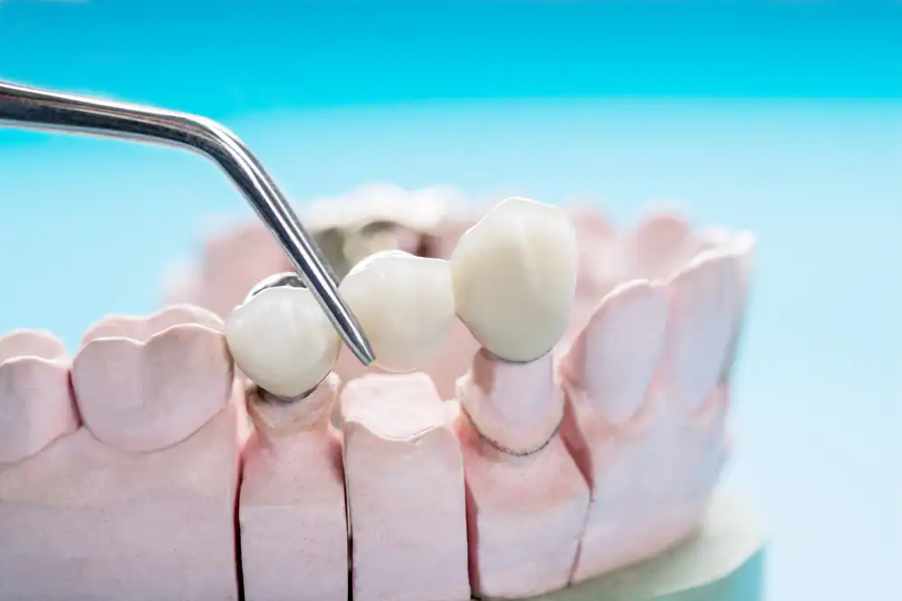 Dental-Bridges
