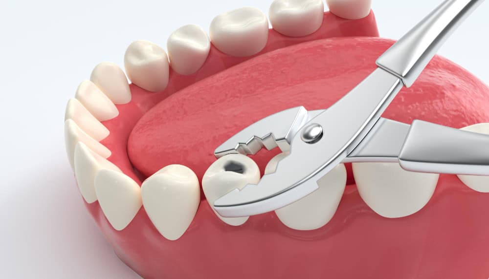 Dental extraction procedure with patient smiling