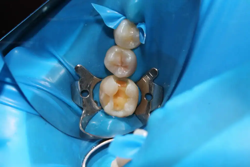 Hands holding a dental model