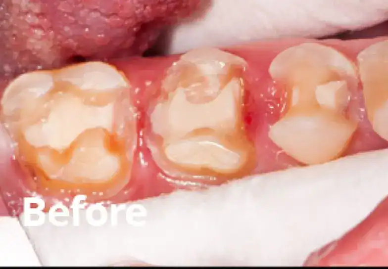 Dental teeth before restoration treatment