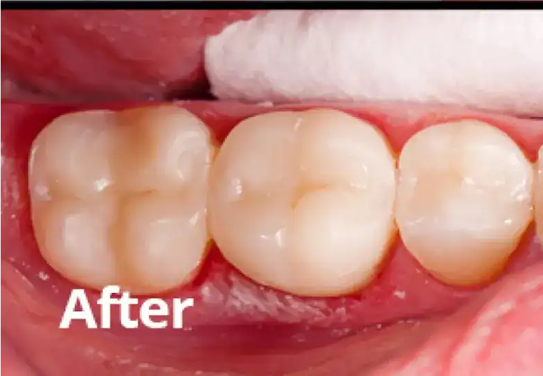 Restored teeth with natural appearance