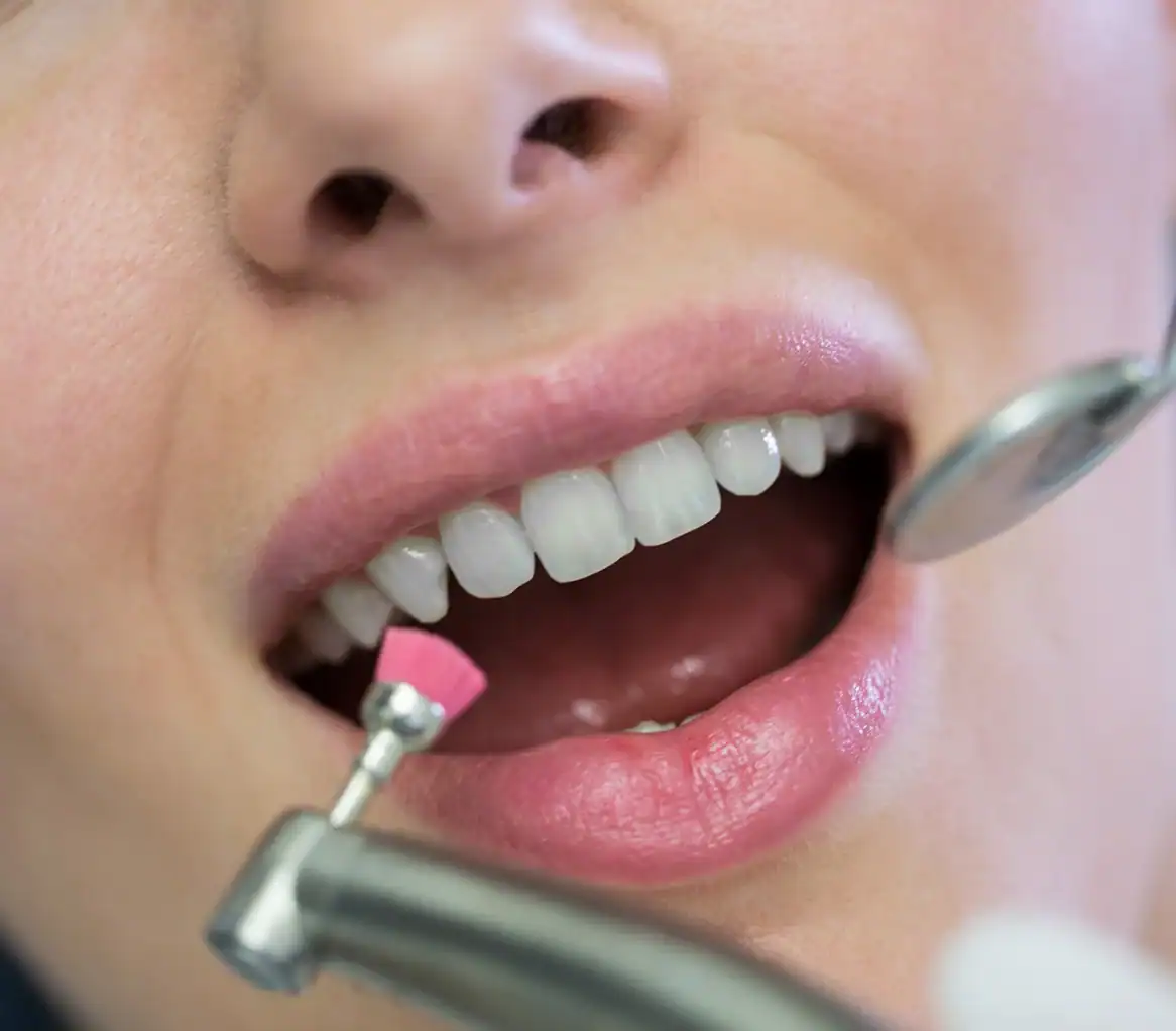 Teeth whitening image