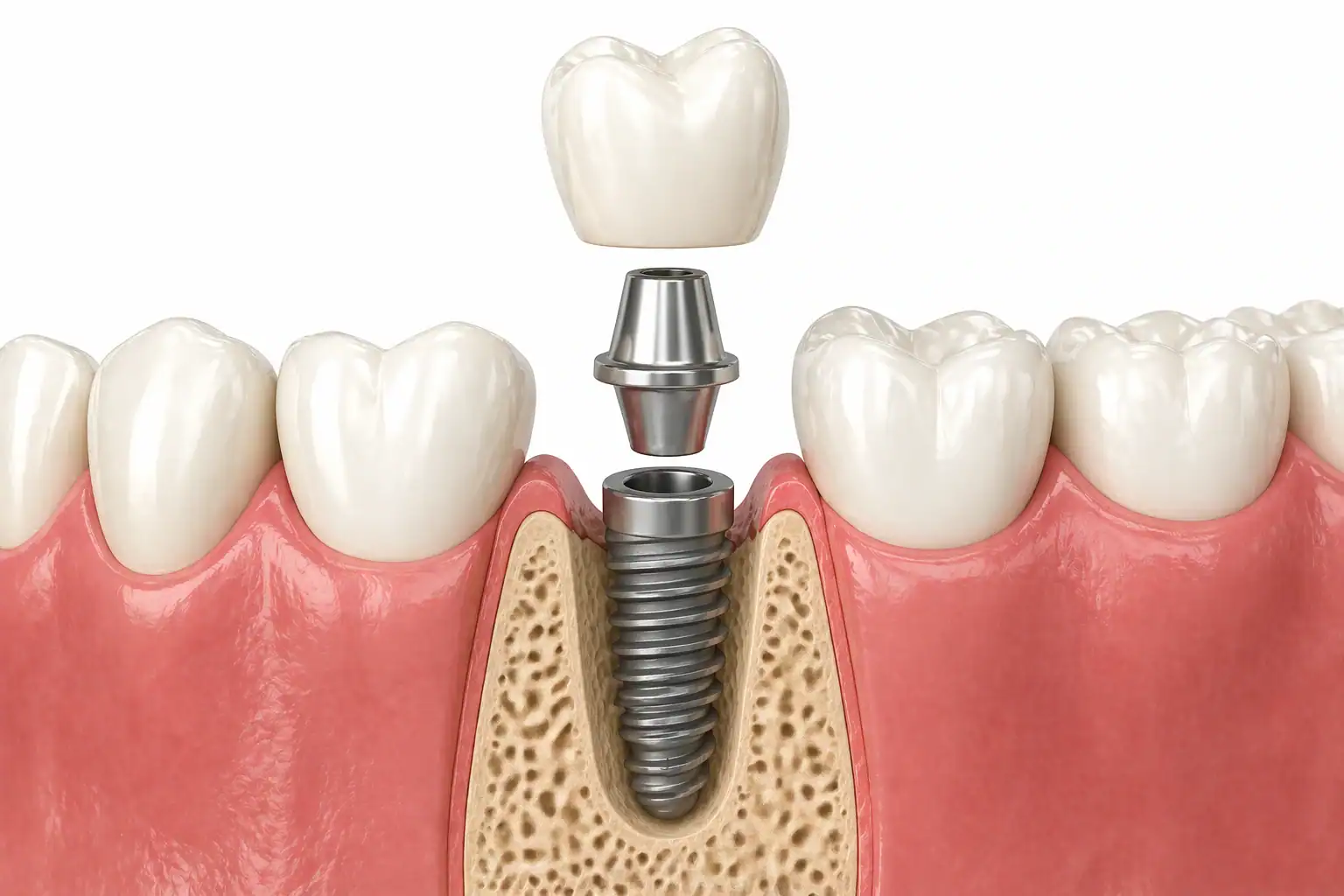 Dentist explaining dental implants to patient