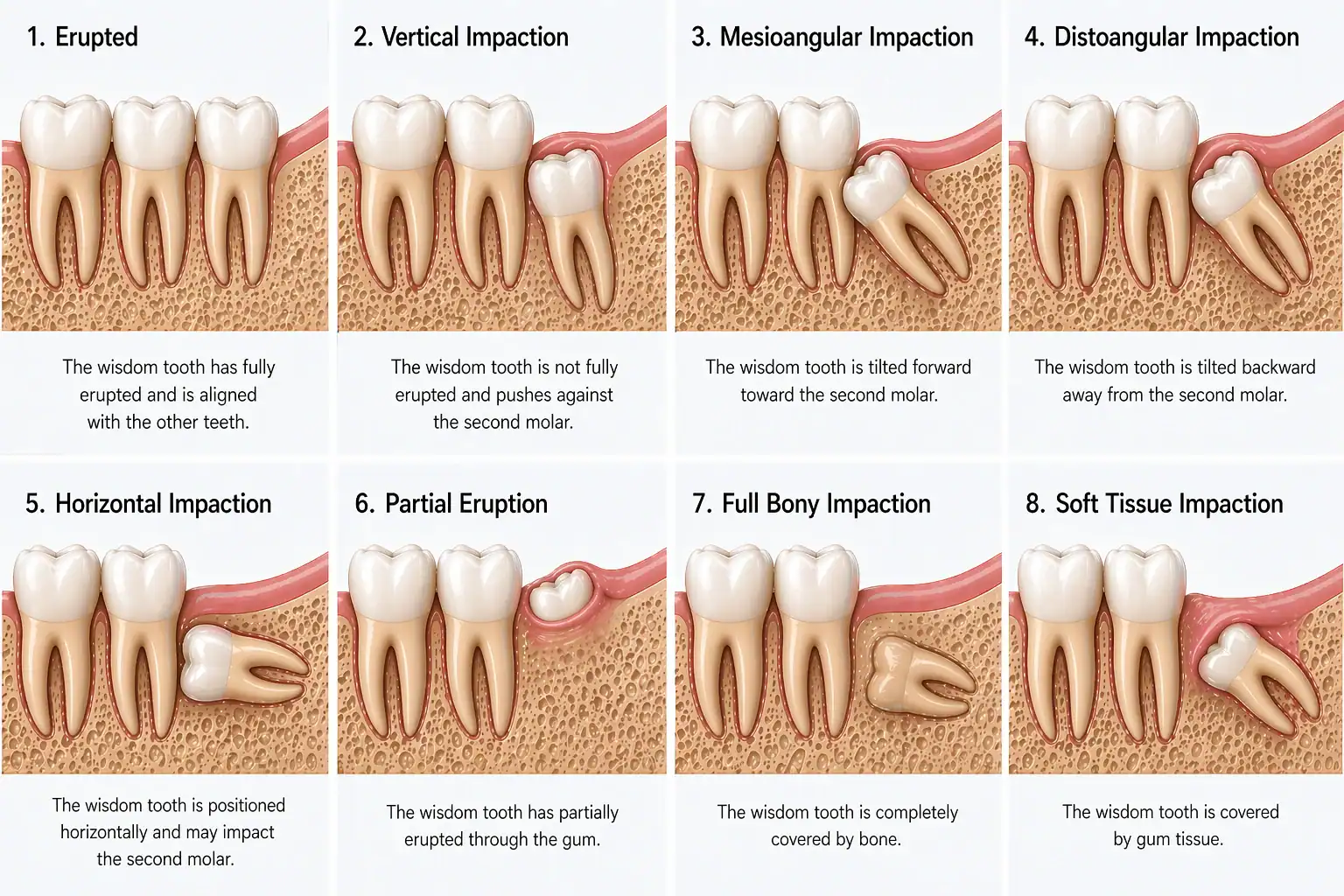 wisdom teeth types Dentist reviewing 3D X-ray of wisdom teeth in Prahran
