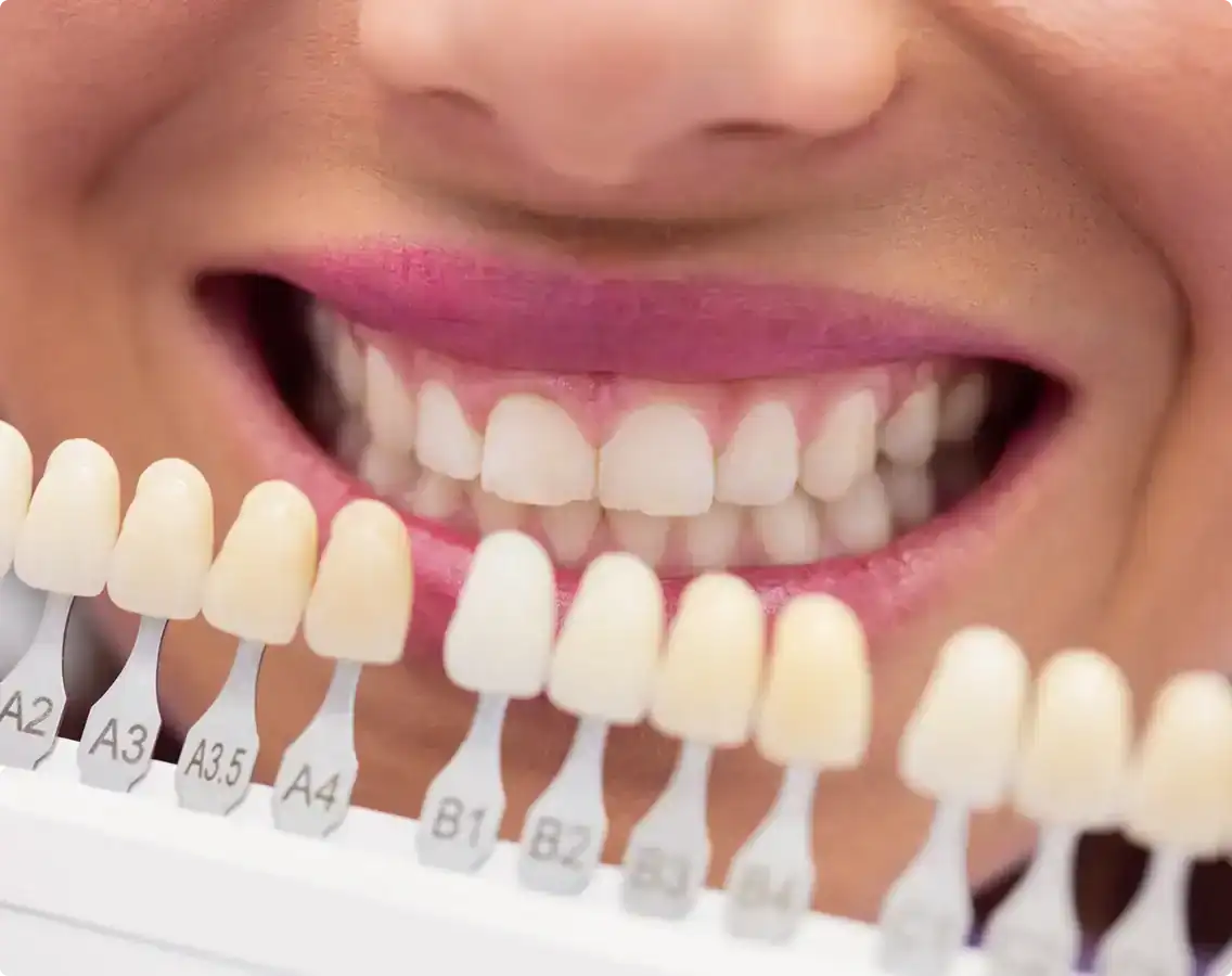 Porcelain Veneers