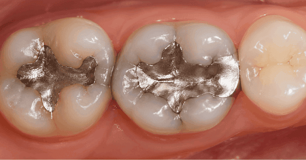Replacing Amalgam Fillings