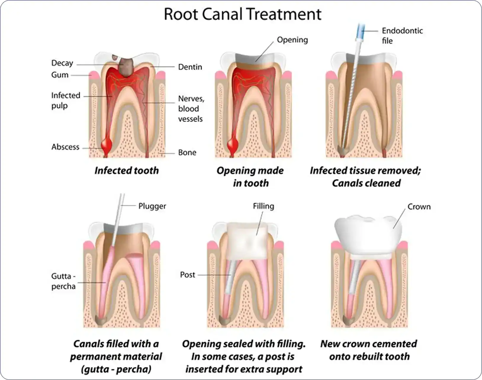 Root Canal Treatment Procedure Root Canal Treatment Procedure