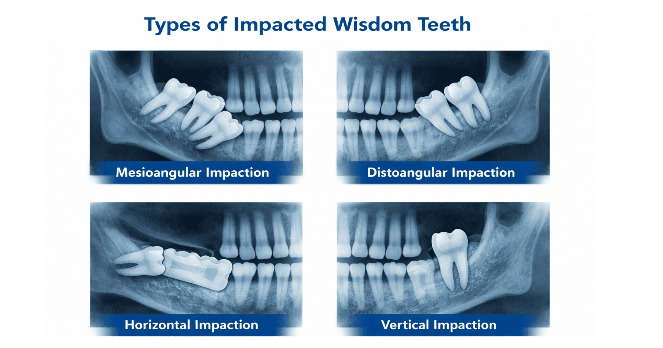 X-ray-showing-different-types-of-impacted-wisdom-teeth-in-Prahran
