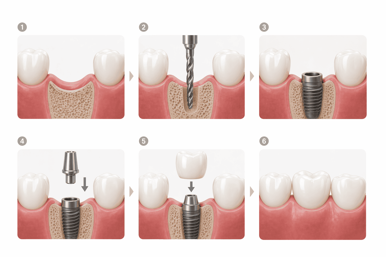 implant procedure straumann implant