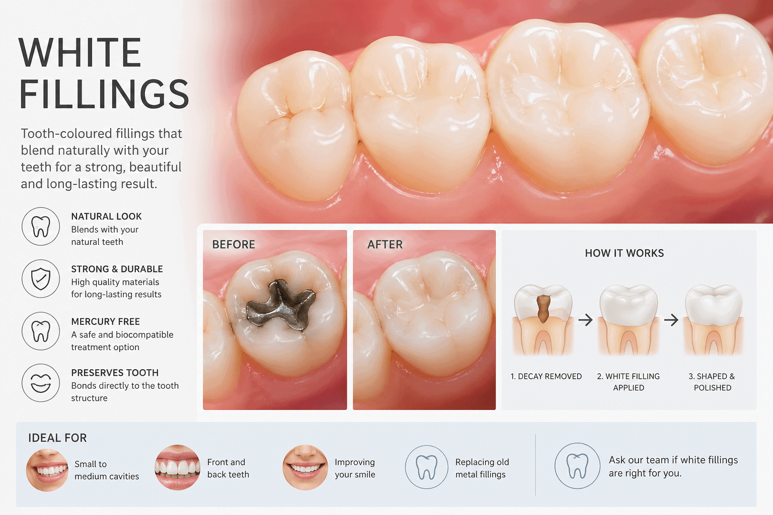 white fillings