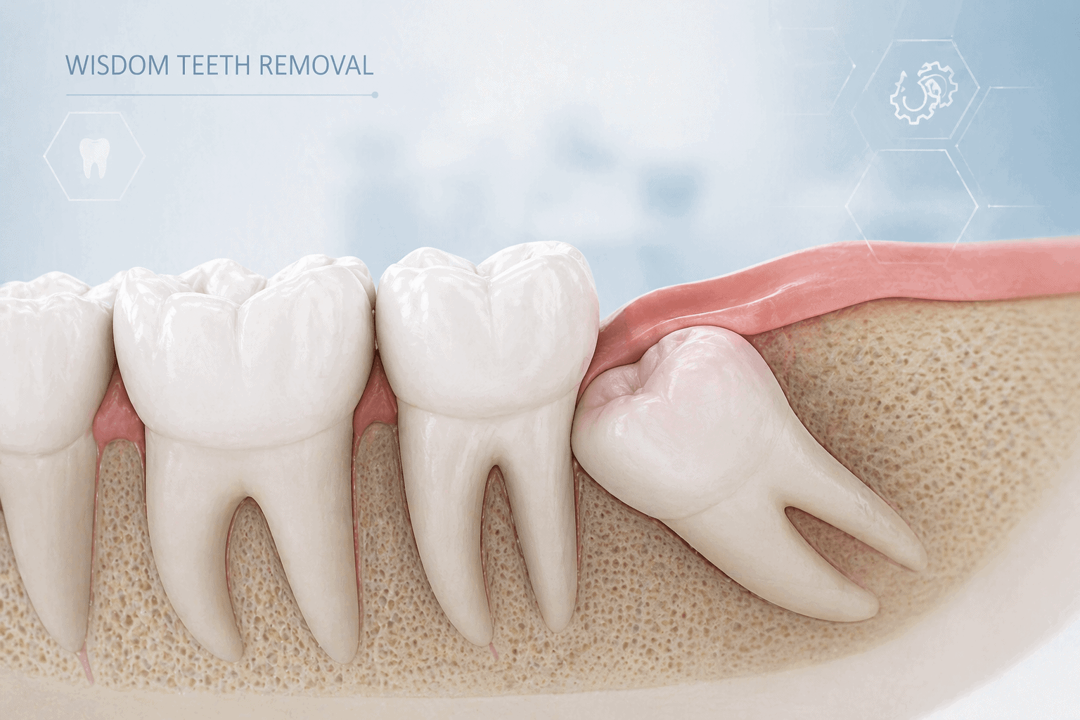 wisdom teeth removal image
