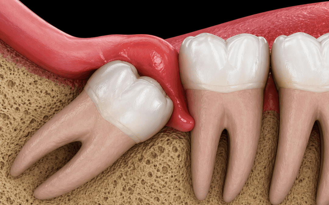 Wisdom Teeth Removal Cost: What Affects the Price and Your Options