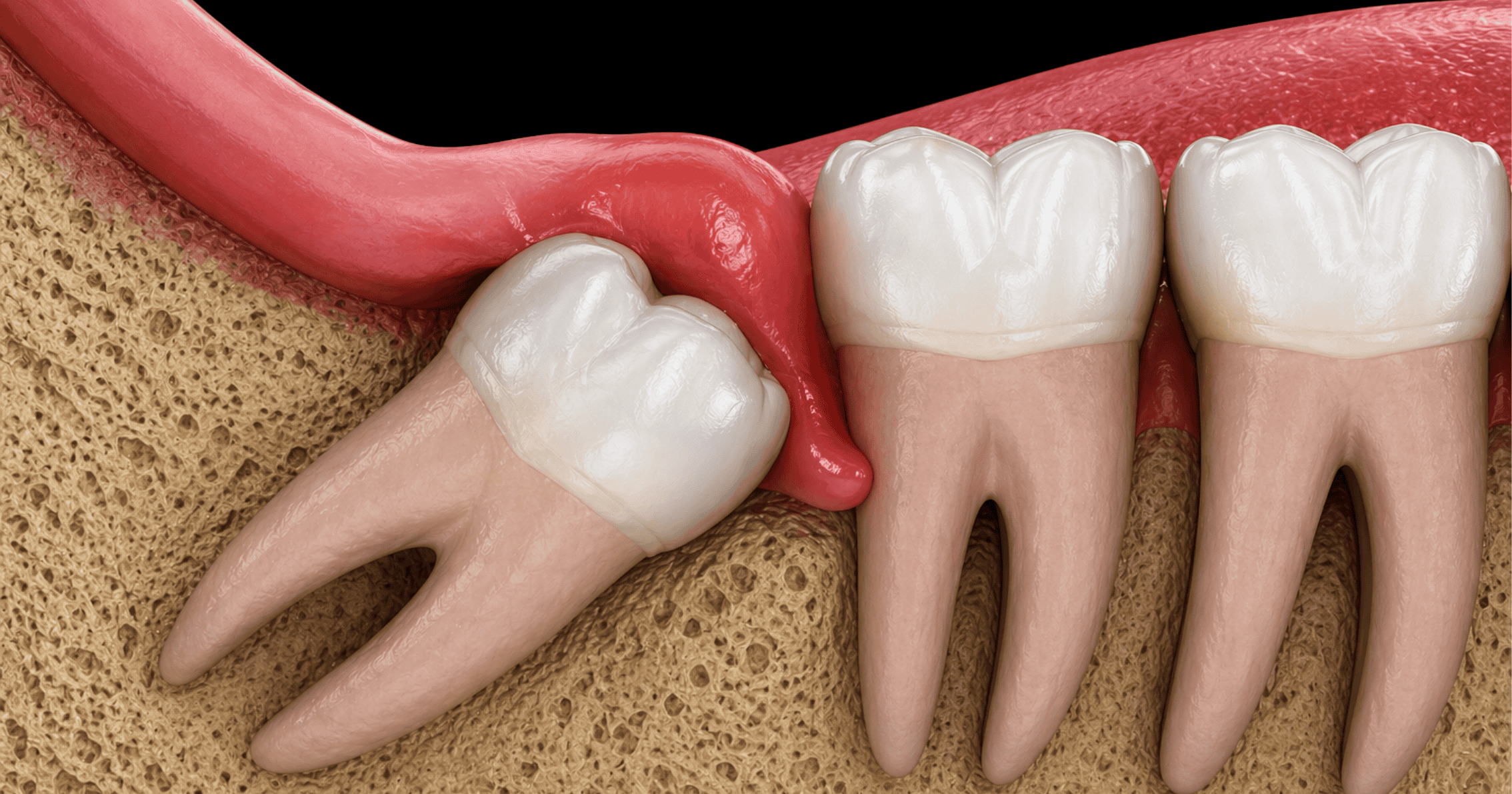 Wisdom Teeth Removal Cost_ What Affects the Price and Your Options Wisdom Teeth Removal Cost_ What Affects the Price and Your Options