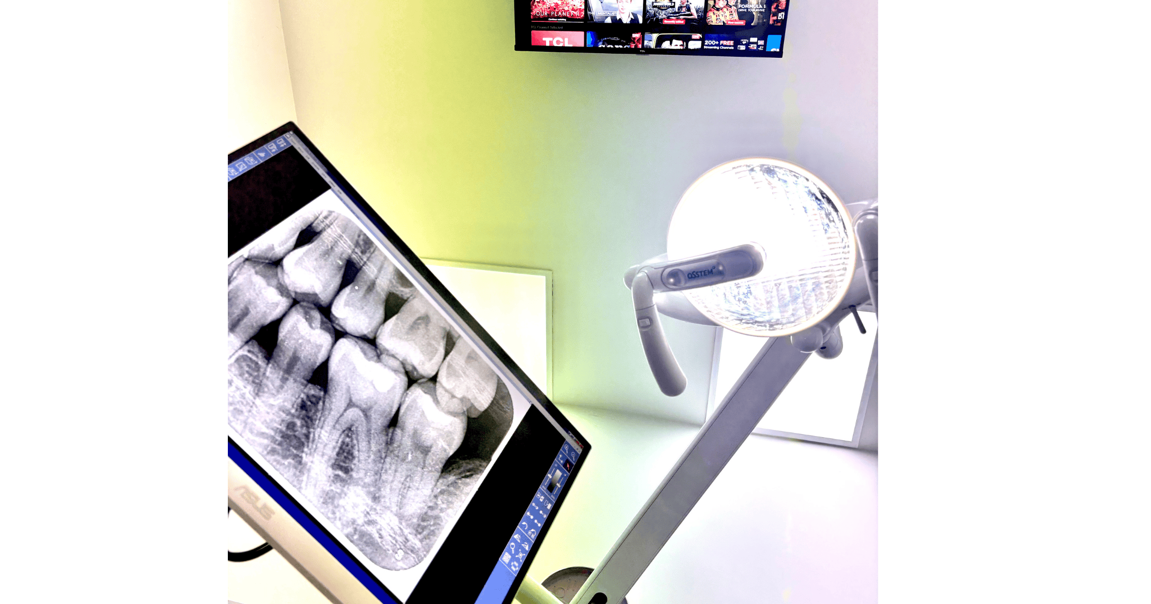 X-ray showing factors that affect wisdom teeth removal cost, including impaction and anaesthetic type