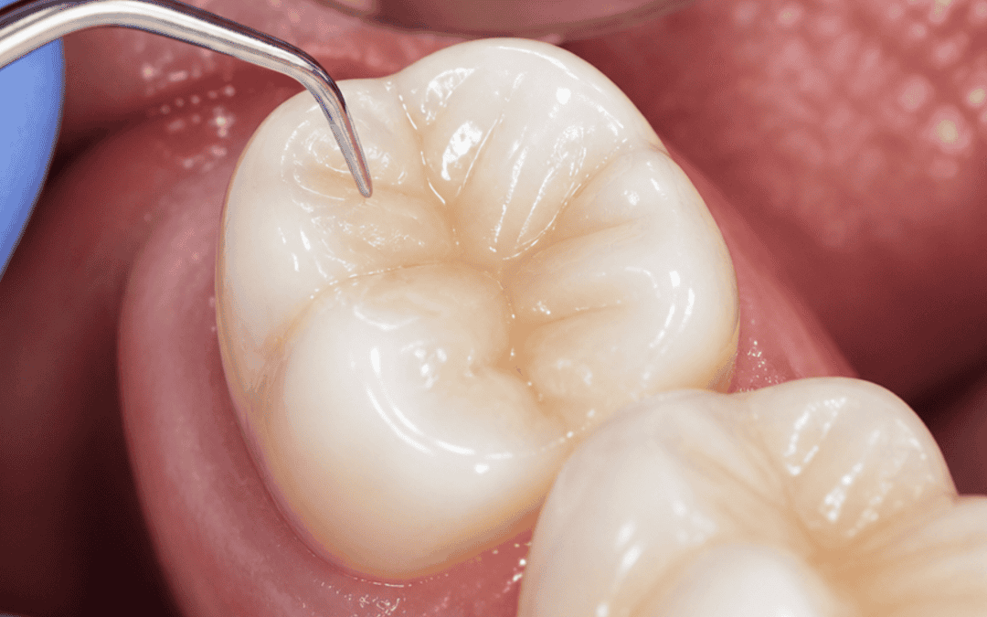 White Fillings in Prahran: What They Are and When You Need One