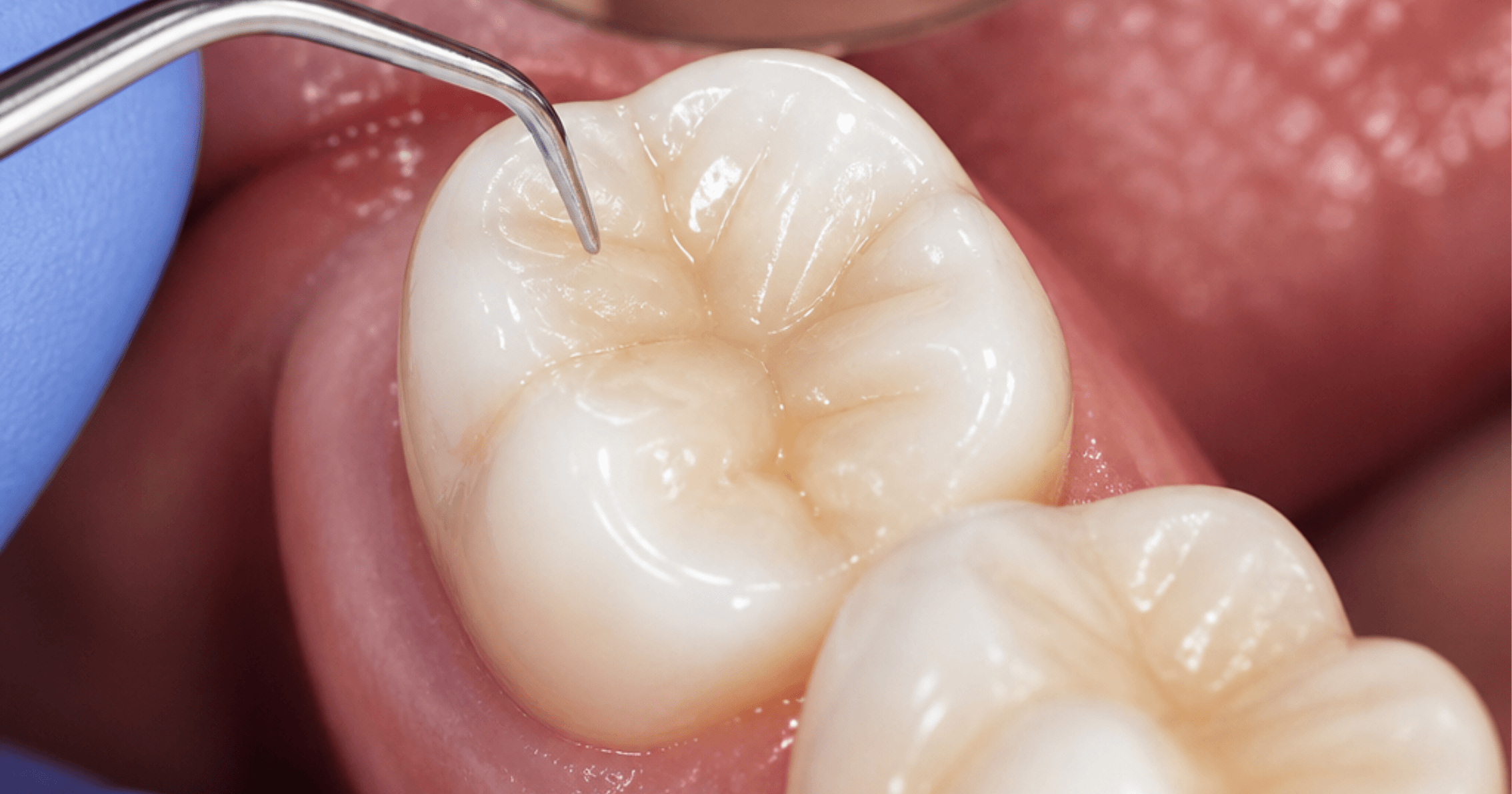 tooth-coloured filling restoration in Prahran