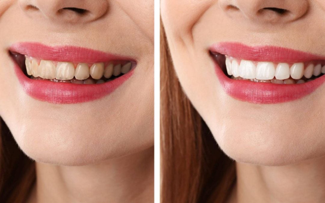 Stained or Yellow Teeth? Here’s What’s Behind It and What Helps