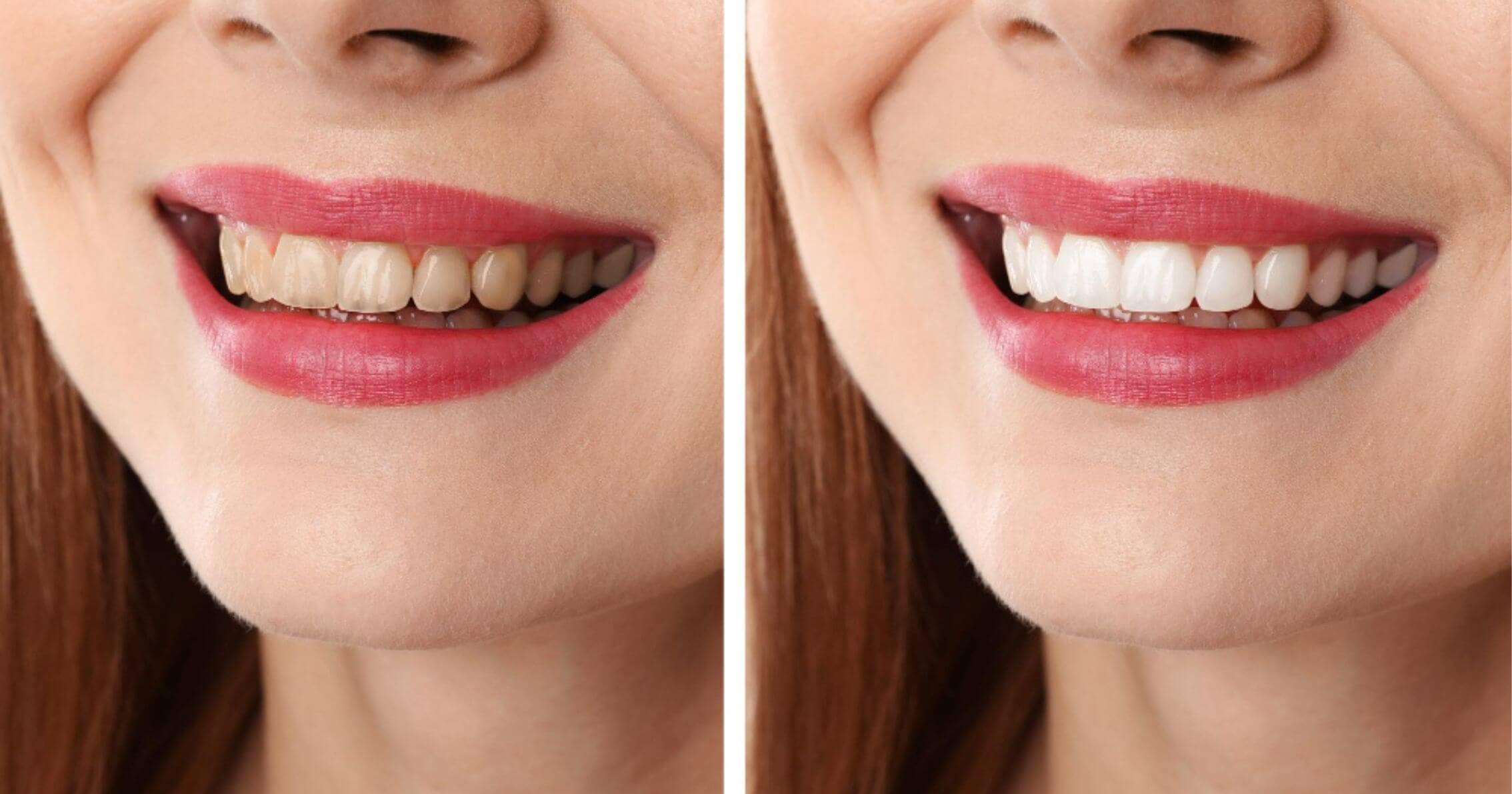 Close-up comparison of yellow stained teeth and whitened teeth in Prahran