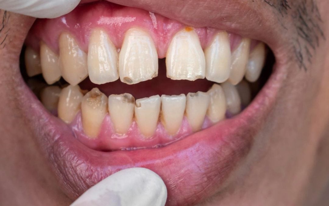 Chipped Tooth: What to Do and How It’s Repaired