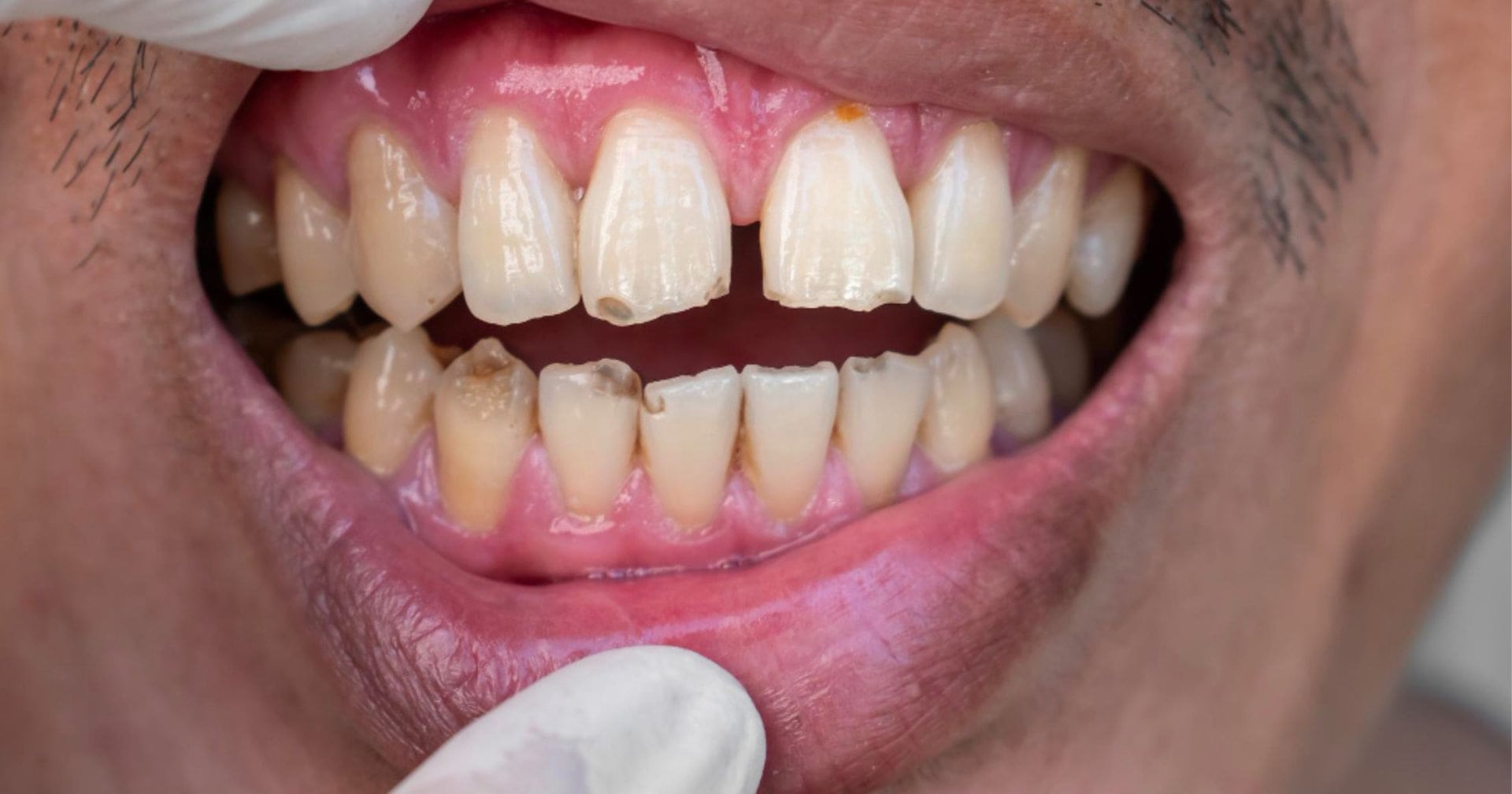 Chipped front teeth with a visible gap in Prahran