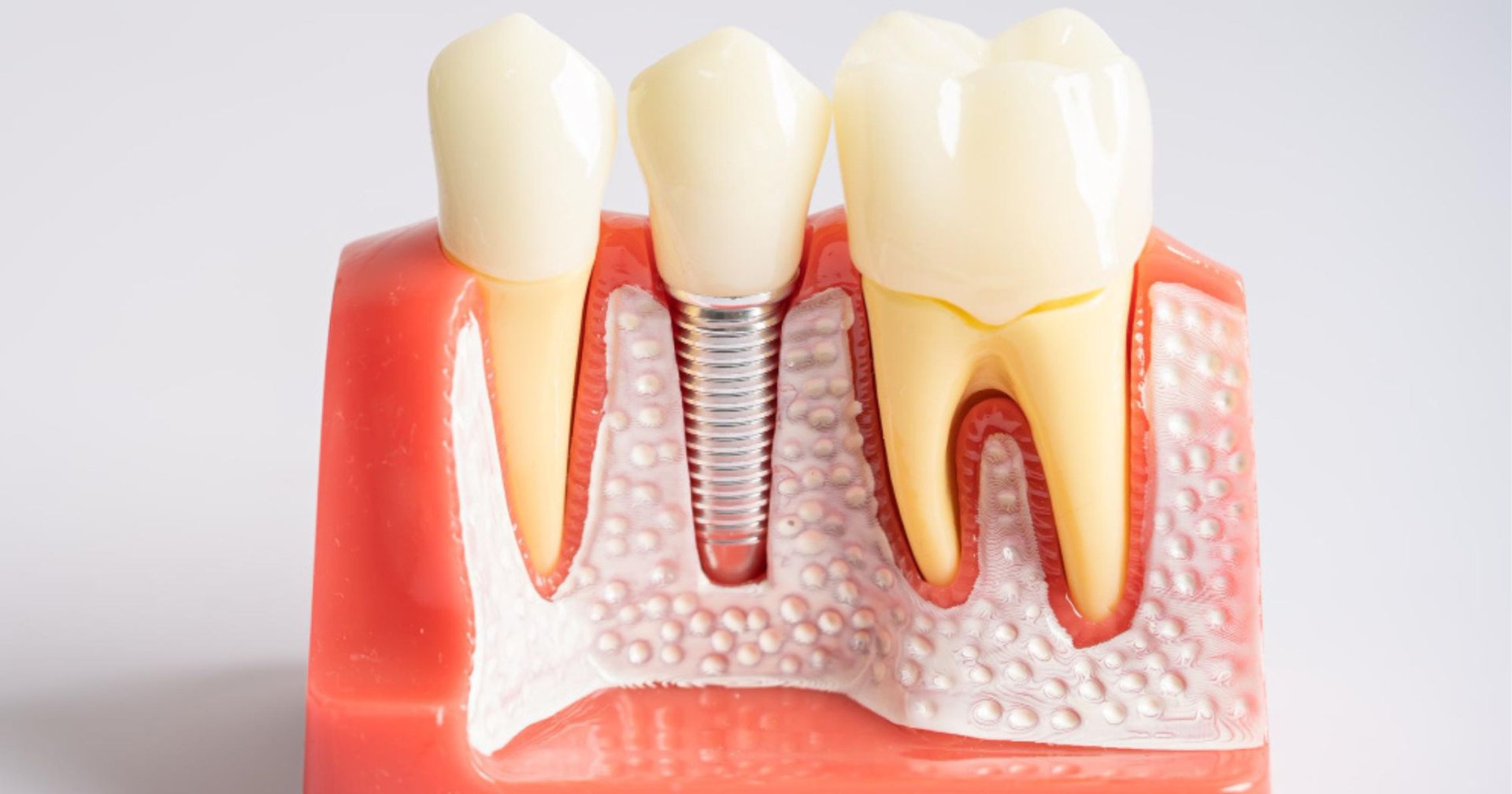 Diagram showing titanium implant post, abutment and crown in the jaw