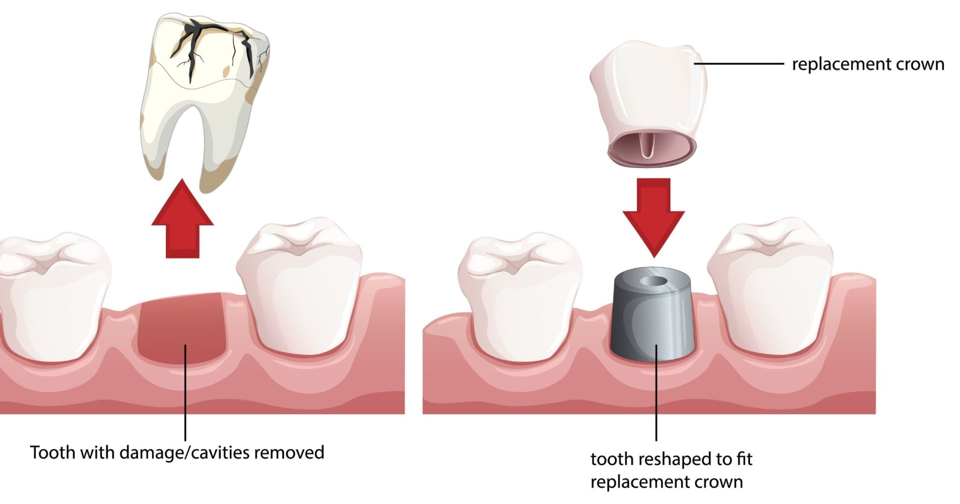 Illustration of dental crown placement in Prahran