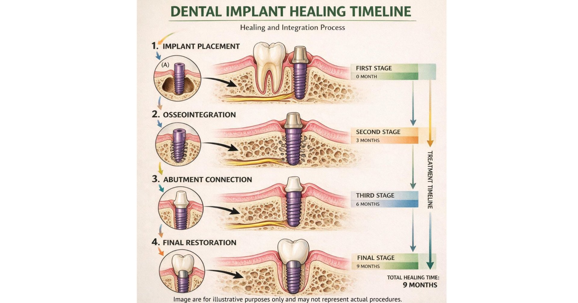 Illustration of the dental implant healing and placement timeline in Prahran