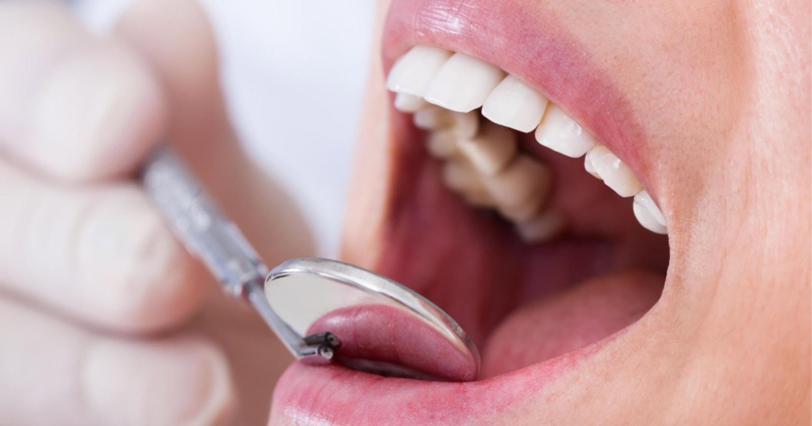 closeup of a dentist examining a patients teeth relevant to identifying teeth grinding in Prahran