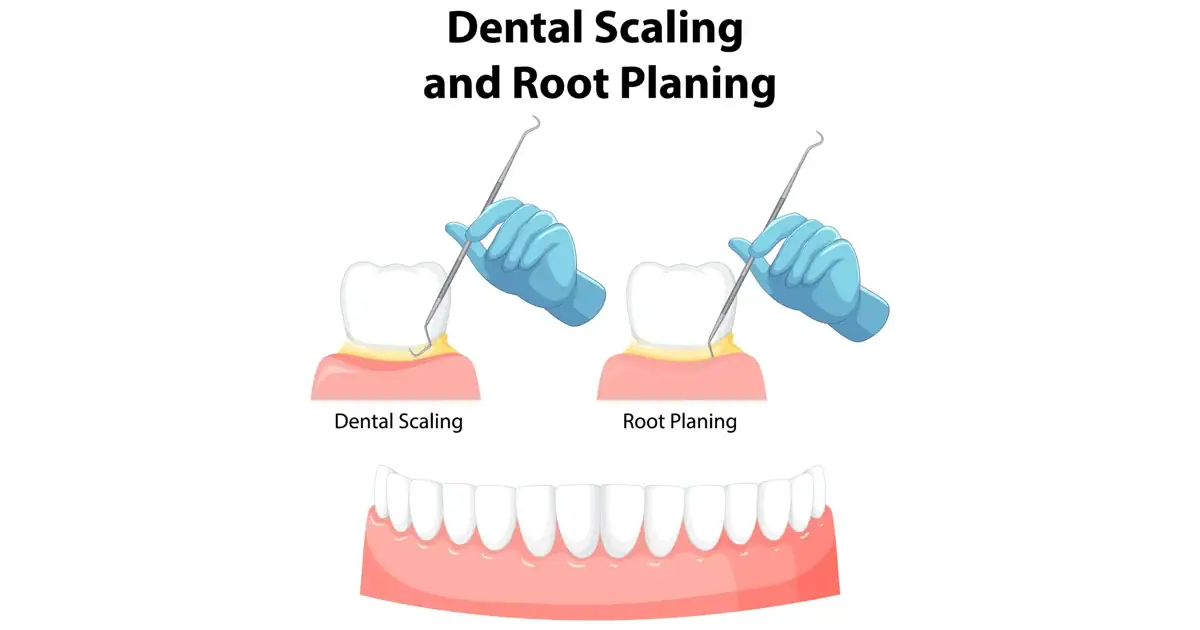 Illustration showing dental scaling and root planing in Prahran